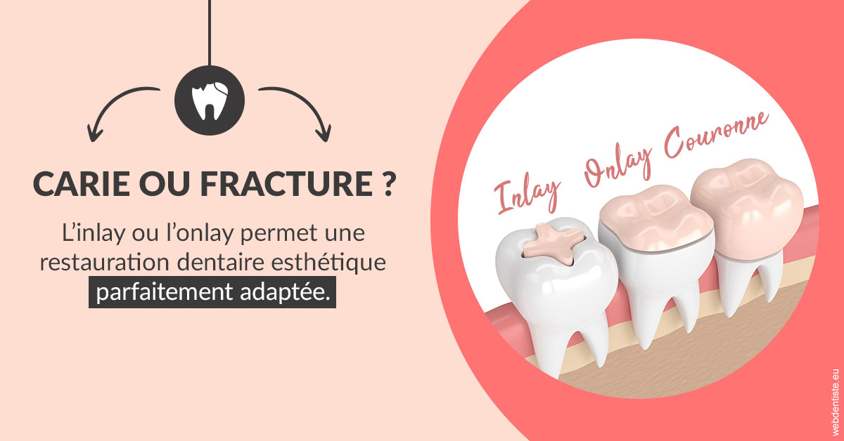 https://www.orthodontiste-st-etienne.fr/T2 2023 - Carie ou fracture 2