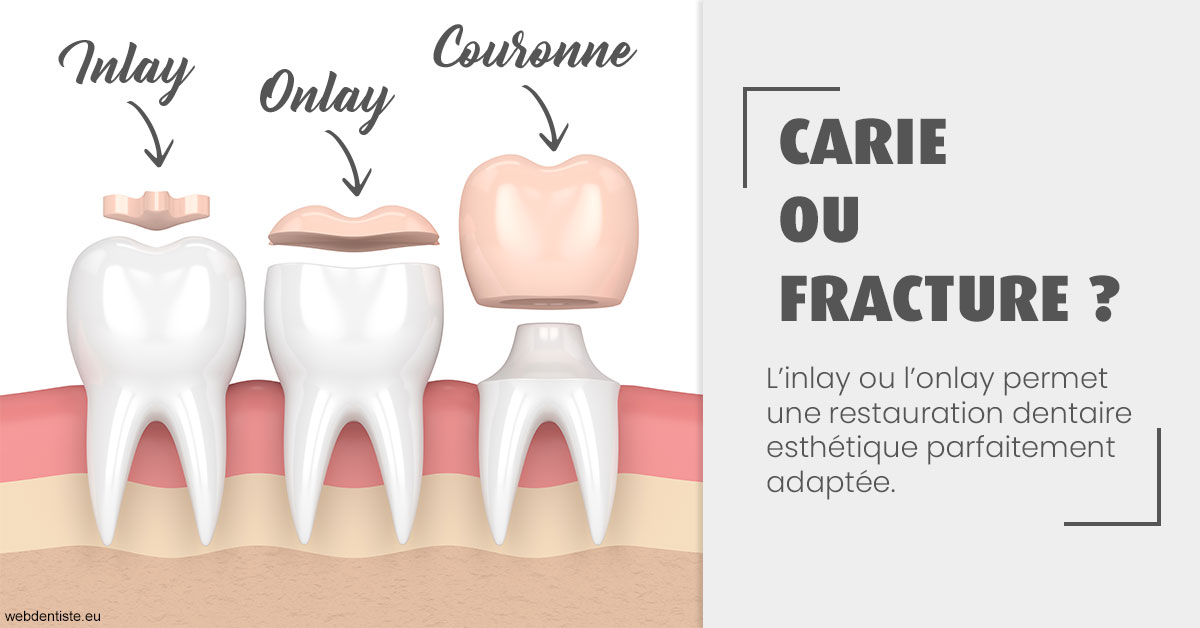 https://www.orthodontiste-st-etienne.fr/T2 2023 - Carie ou fracture 1