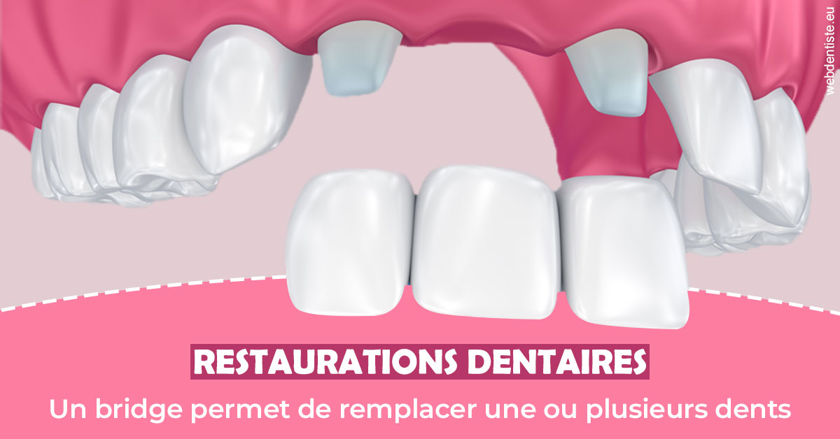 https://www.orthodontiste-st-etienne.fr/Bridge remplacer dents 2