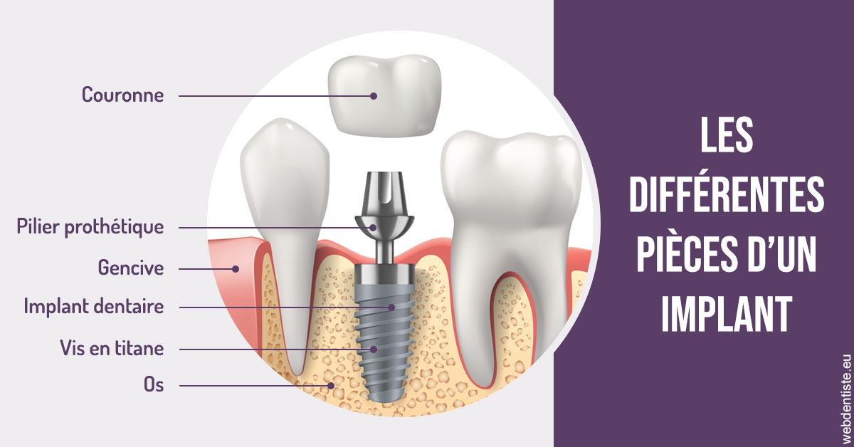 https://www.orthodontiste-st-etienne.fr/Les différentes pièces d’un implant 2