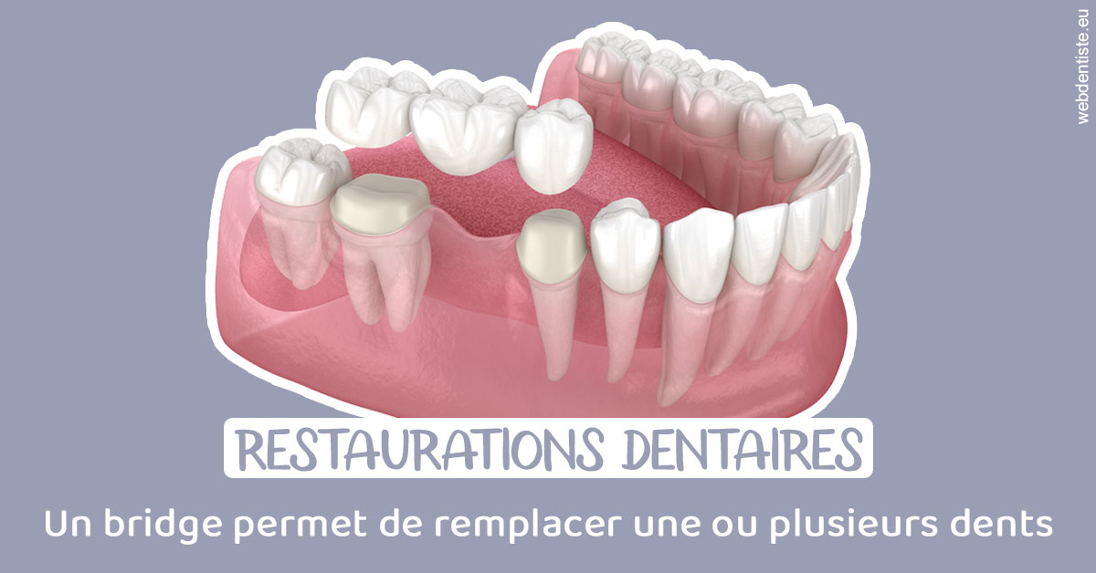 https://www.orthodontiste-st-etienne.fr/Bridge remplacer dents 1