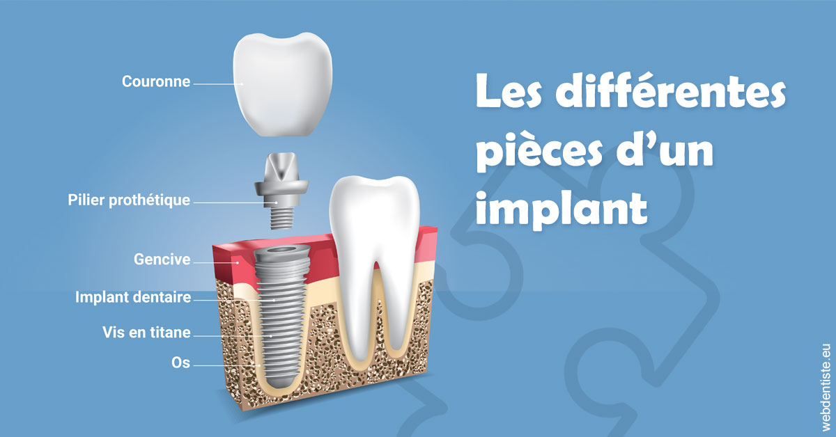https://www.orthodontiste-st-etienne.fr/Les différentes pièces d’un implant 1